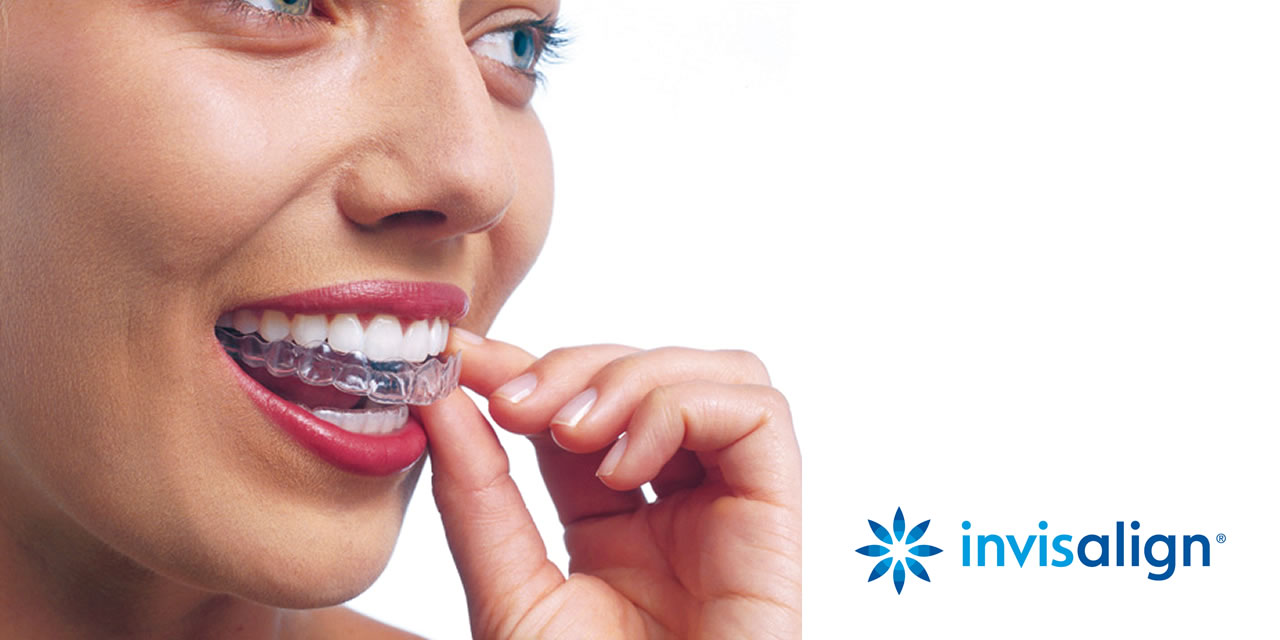 Como funciona invisalign